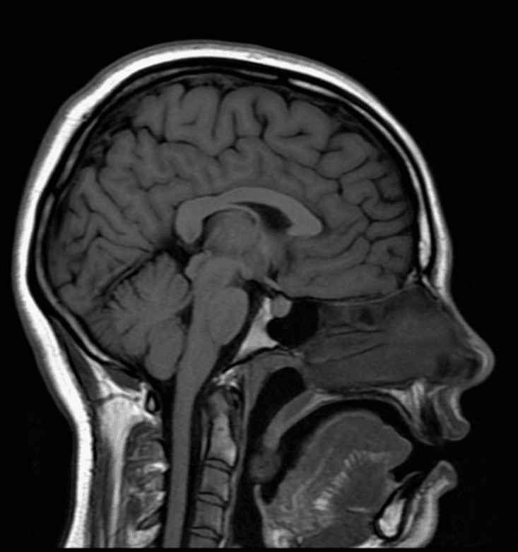 МРТ головного мозга в Санкт‑Петербурге